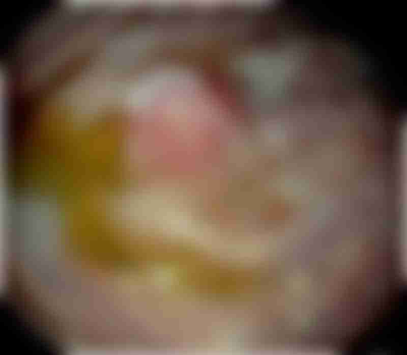 Carcinoid Tumor Stomach Endoscopy